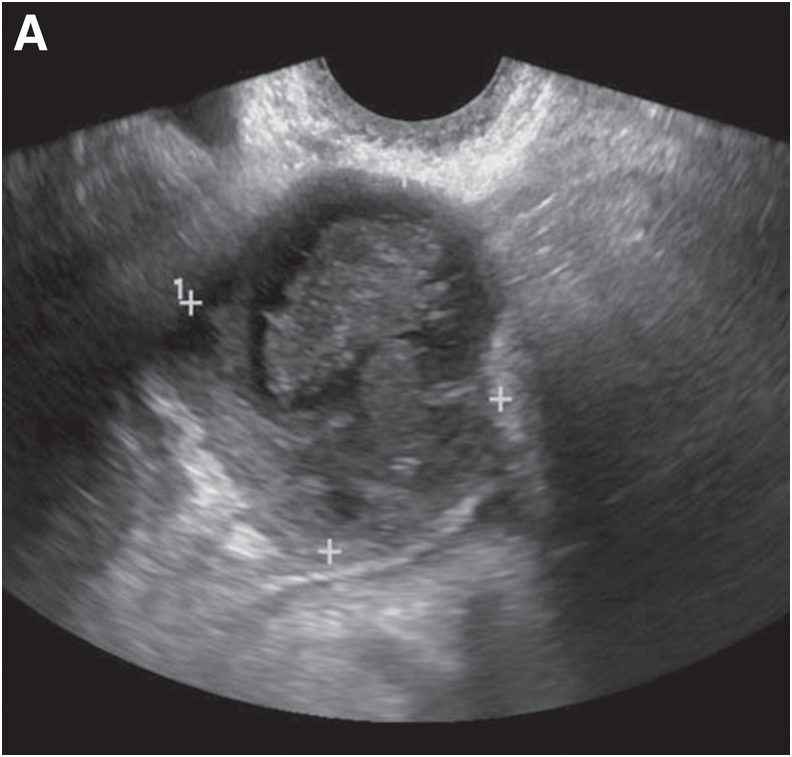 specimen of bilateral hemorrhagic ovarian cysts that ruptured that on