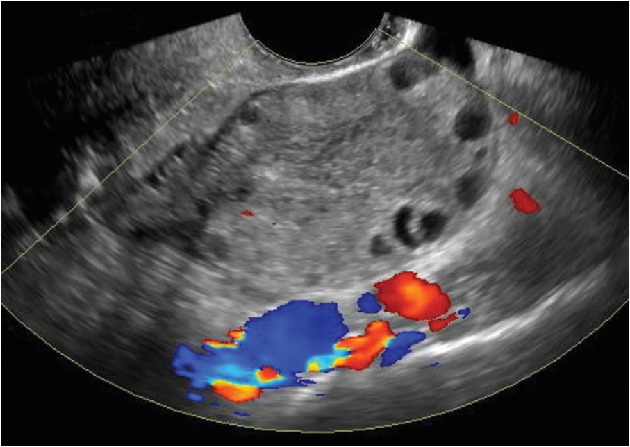 Torsion of paratubal cyst mimicking ovarian torsion: A rare case