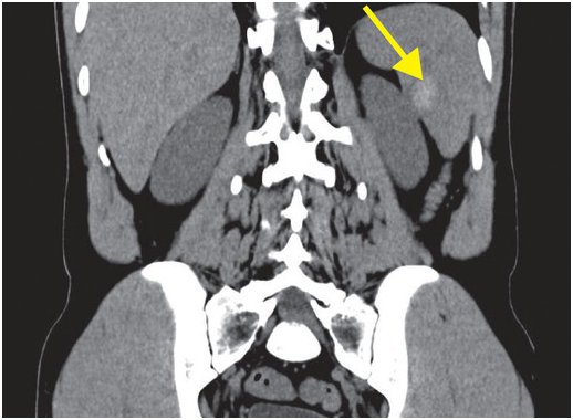Case 4-2013 — A 50-Year-Old Man with Acute Flank Pain