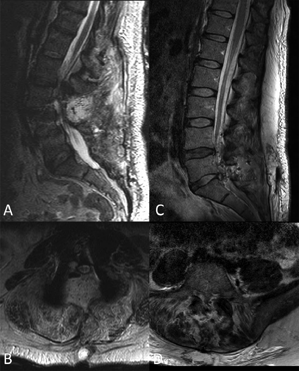 Cervical Spine Fusion C3-C5 ACDF, two views – Stock Trial Exhibits