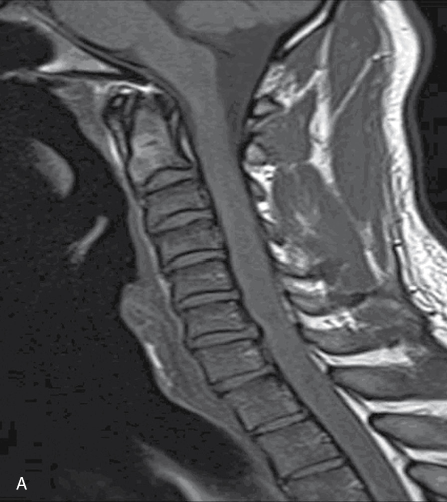 Cervical Spine Fusion C3-C5 ACDF, two views – Stock Trial Exhibits