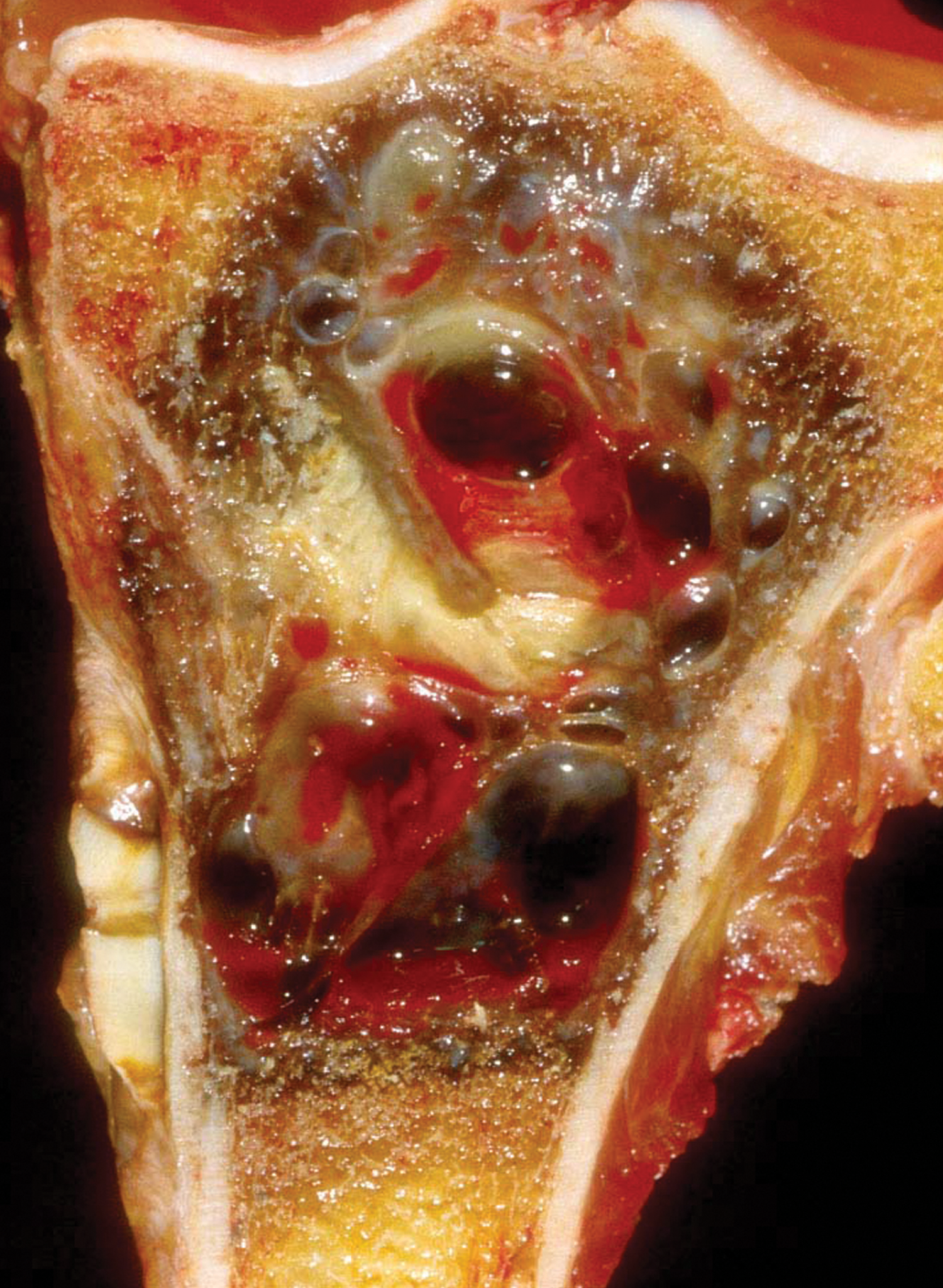 Gross appearance of vaginal mass, dark brown color pigmentated