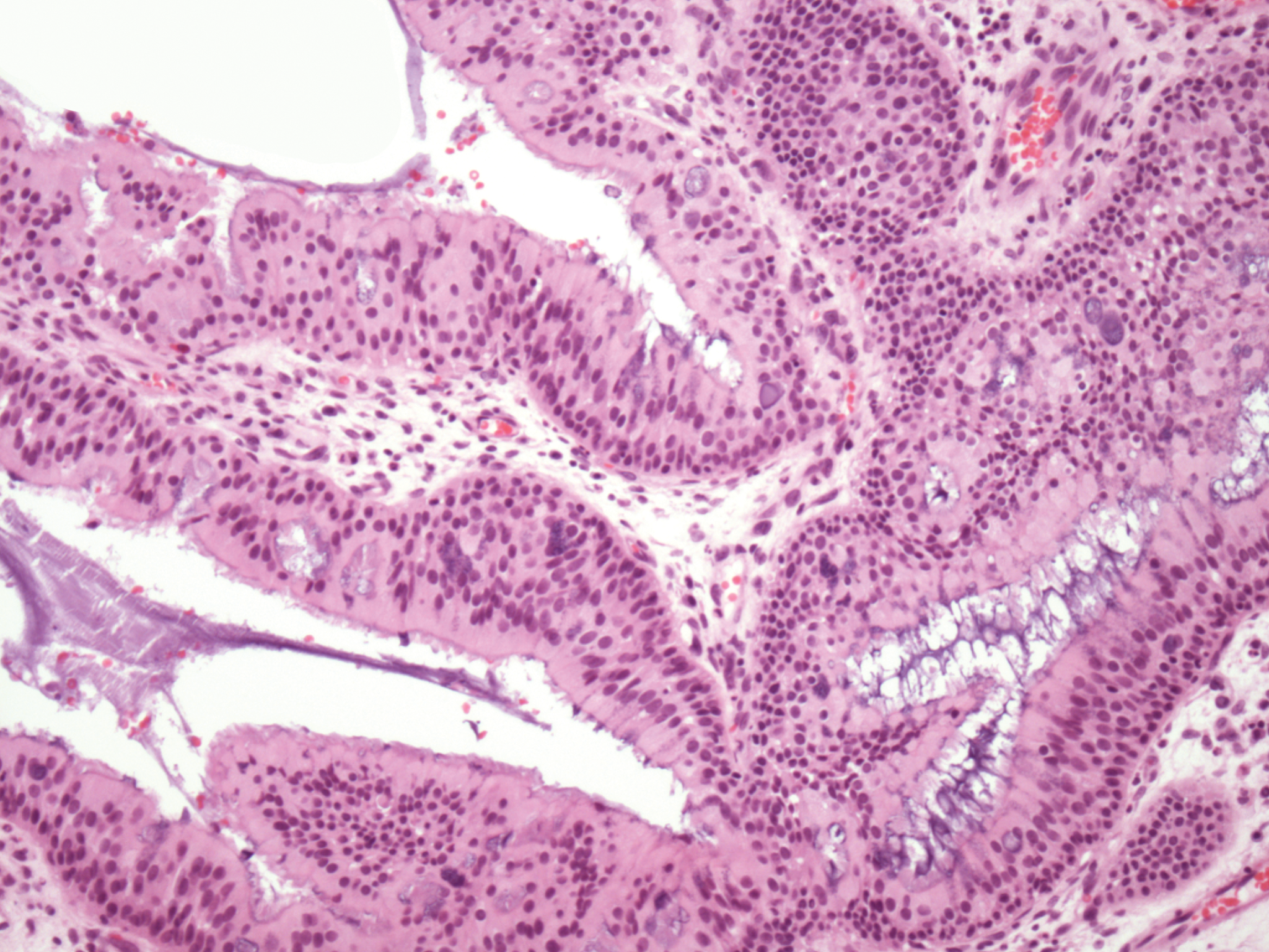 Inverted papilloma nasopharynx