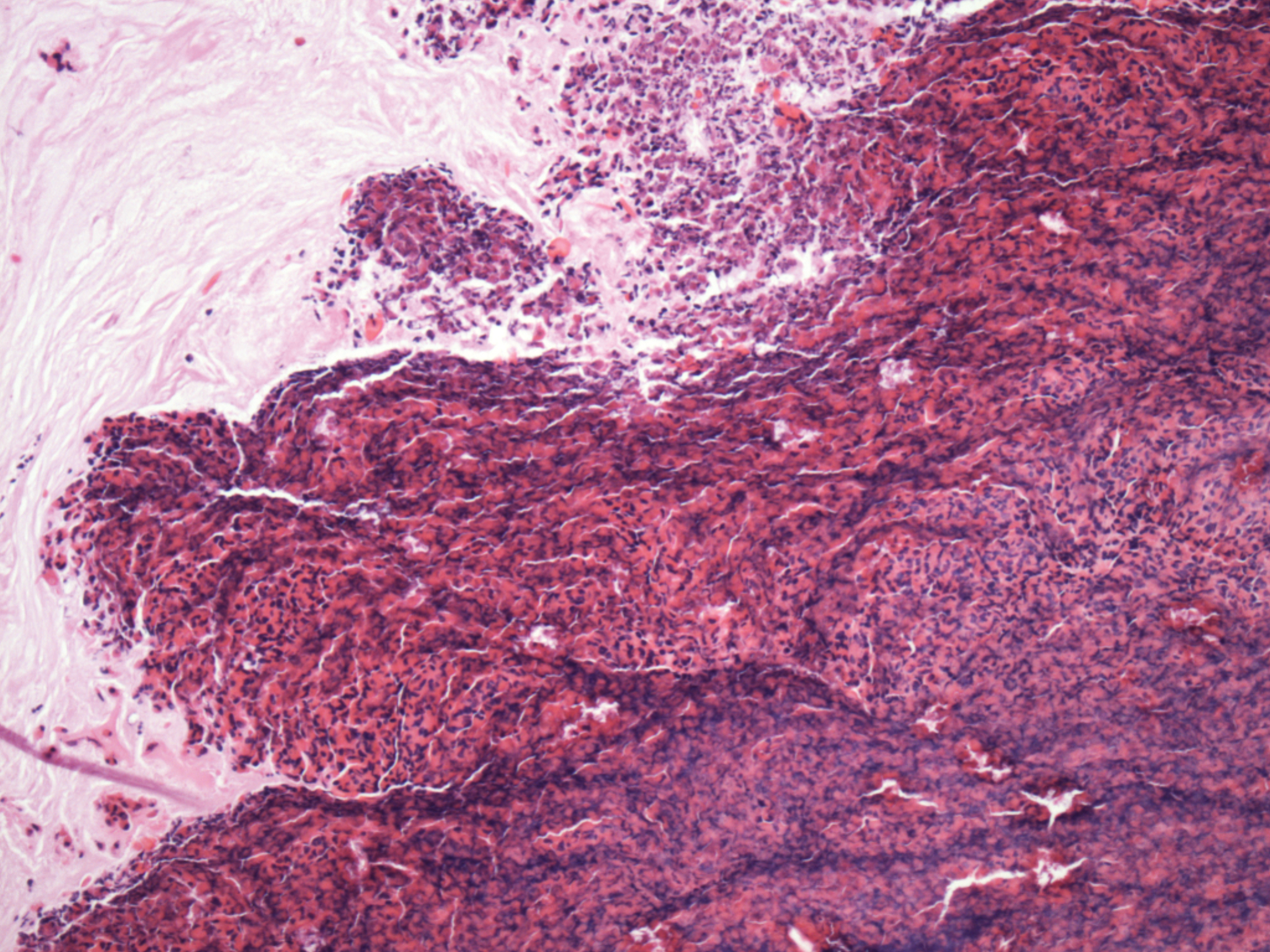 Sinonasal And Nasopharyngeal Pathology Chapter 15 Silverberg S Principles And Practice Of Surgical Pathology And Cytopathology