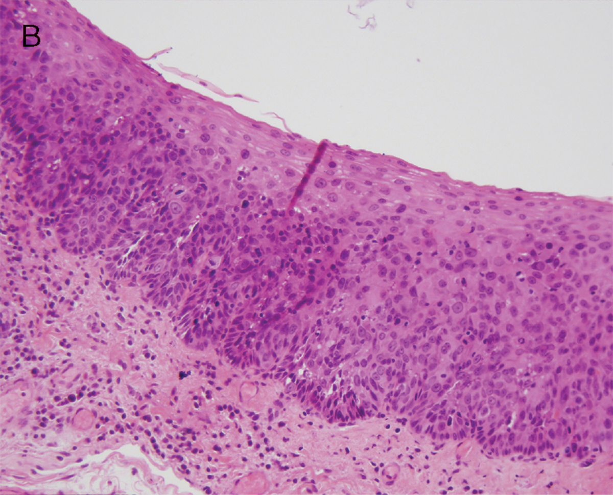 squamous papilloma with severe dysplasia