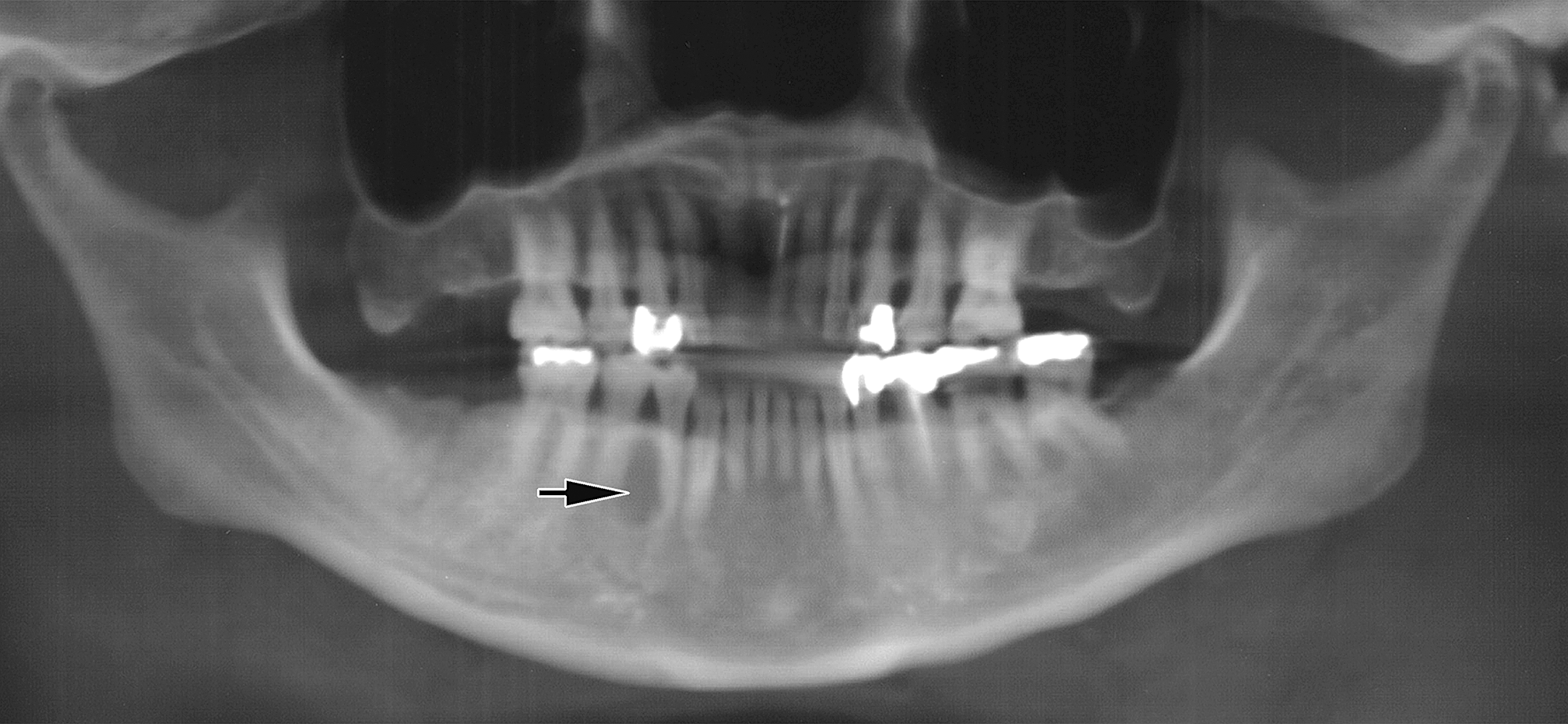 ameloblastoma acantomatoso diabetes canina