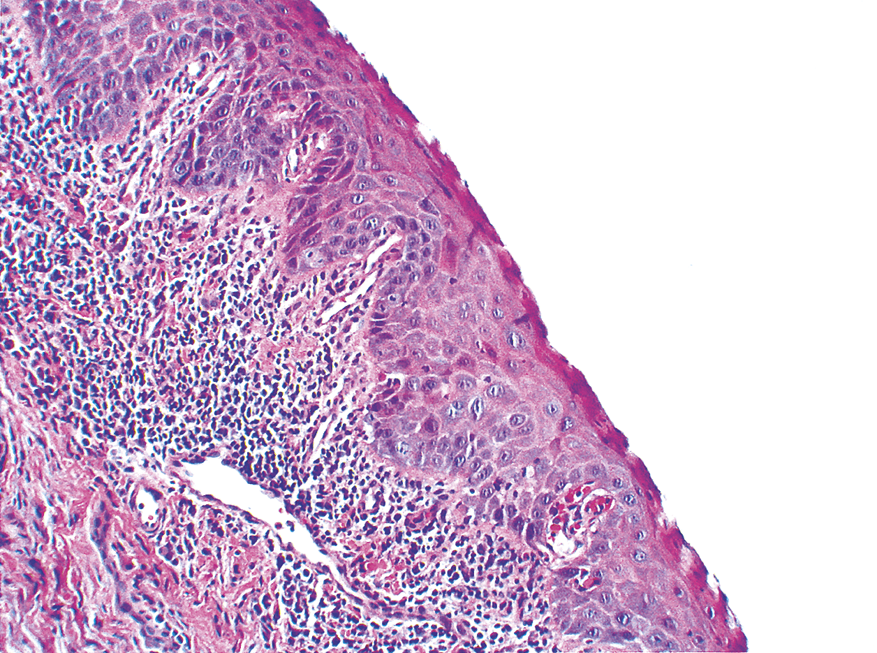 ameloblastoma acantomatoso diabetes canina ameloblastoma acantomatoso diabetes canina