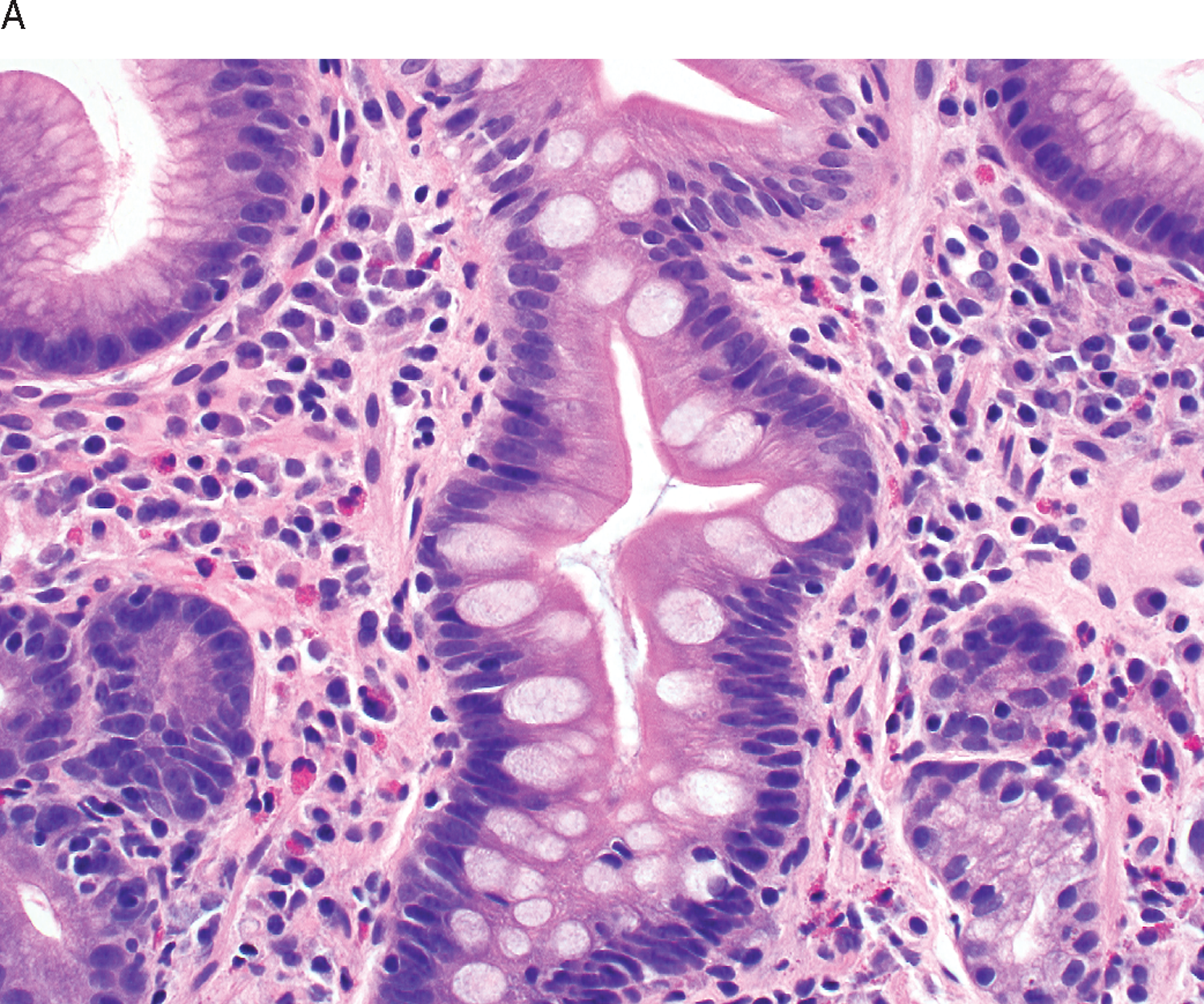 The Stomach Chapter 25 Silverberg S Principles And Practice Of Surgical Pathology And Cytopathology