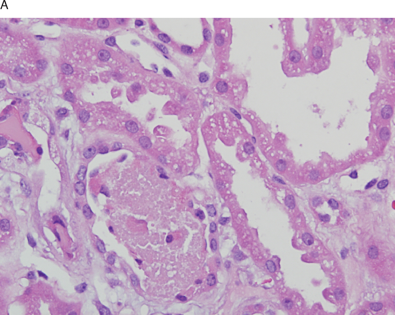 Non-neoplastic renal diseases (Chapter 31) - Silverberg's Principles and  Practice of Surgical Pathology and Cytopathology, image size:1360x1087