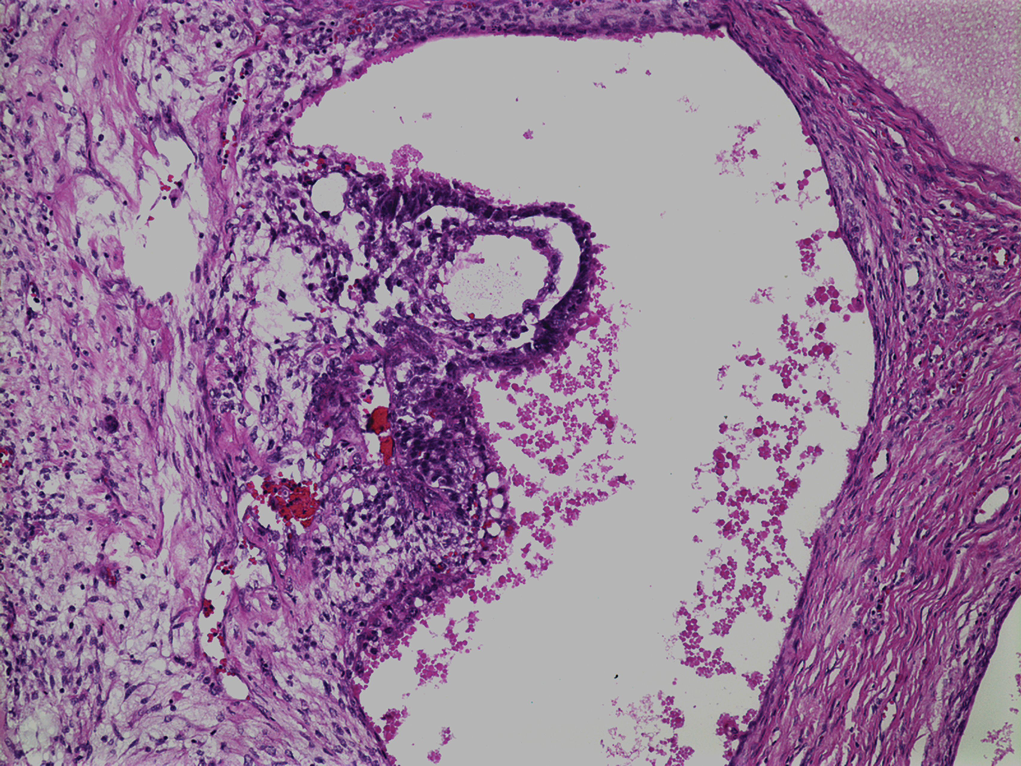 multicystic mesothelioma ovary