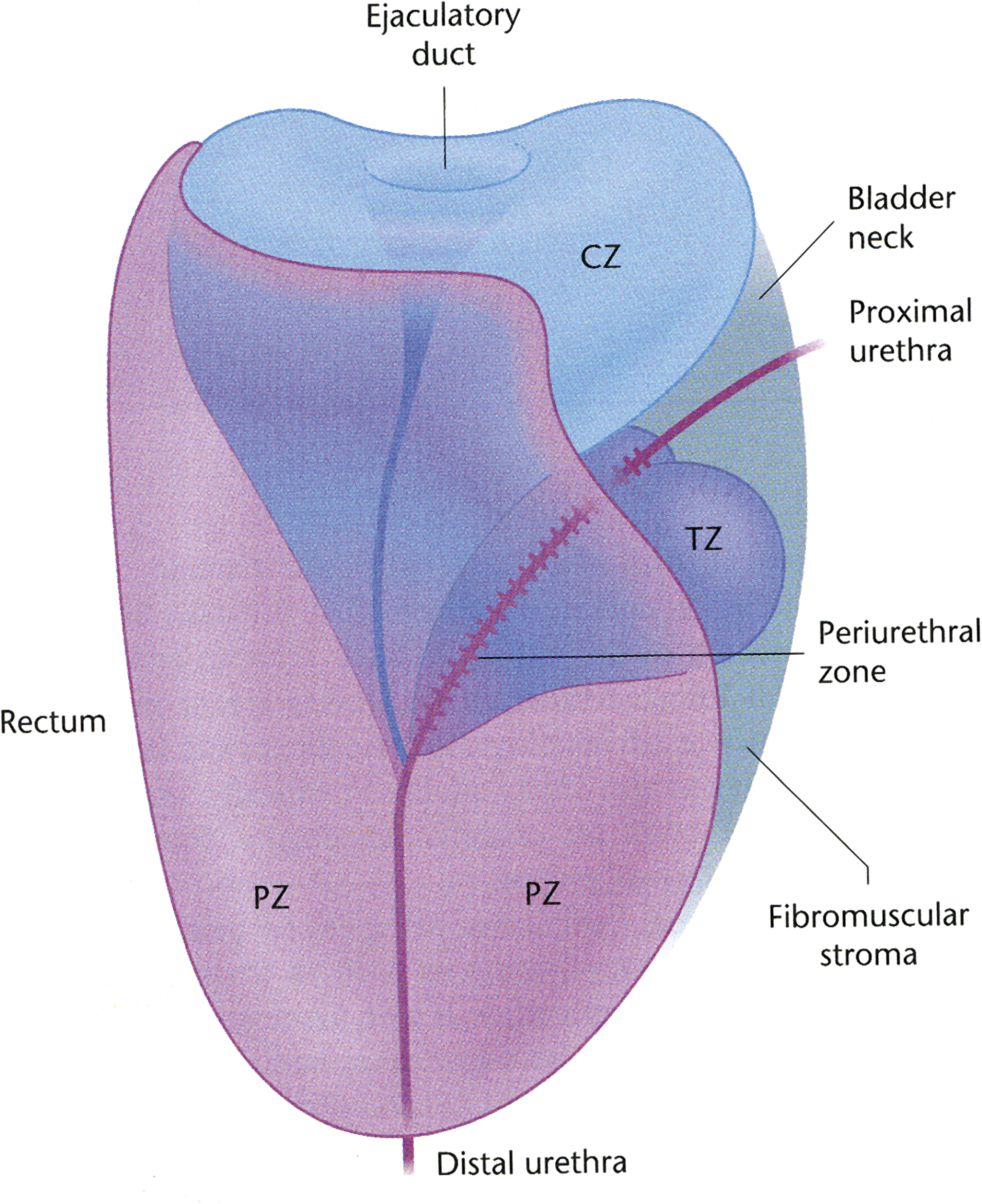 Prostatitis szklerózis)