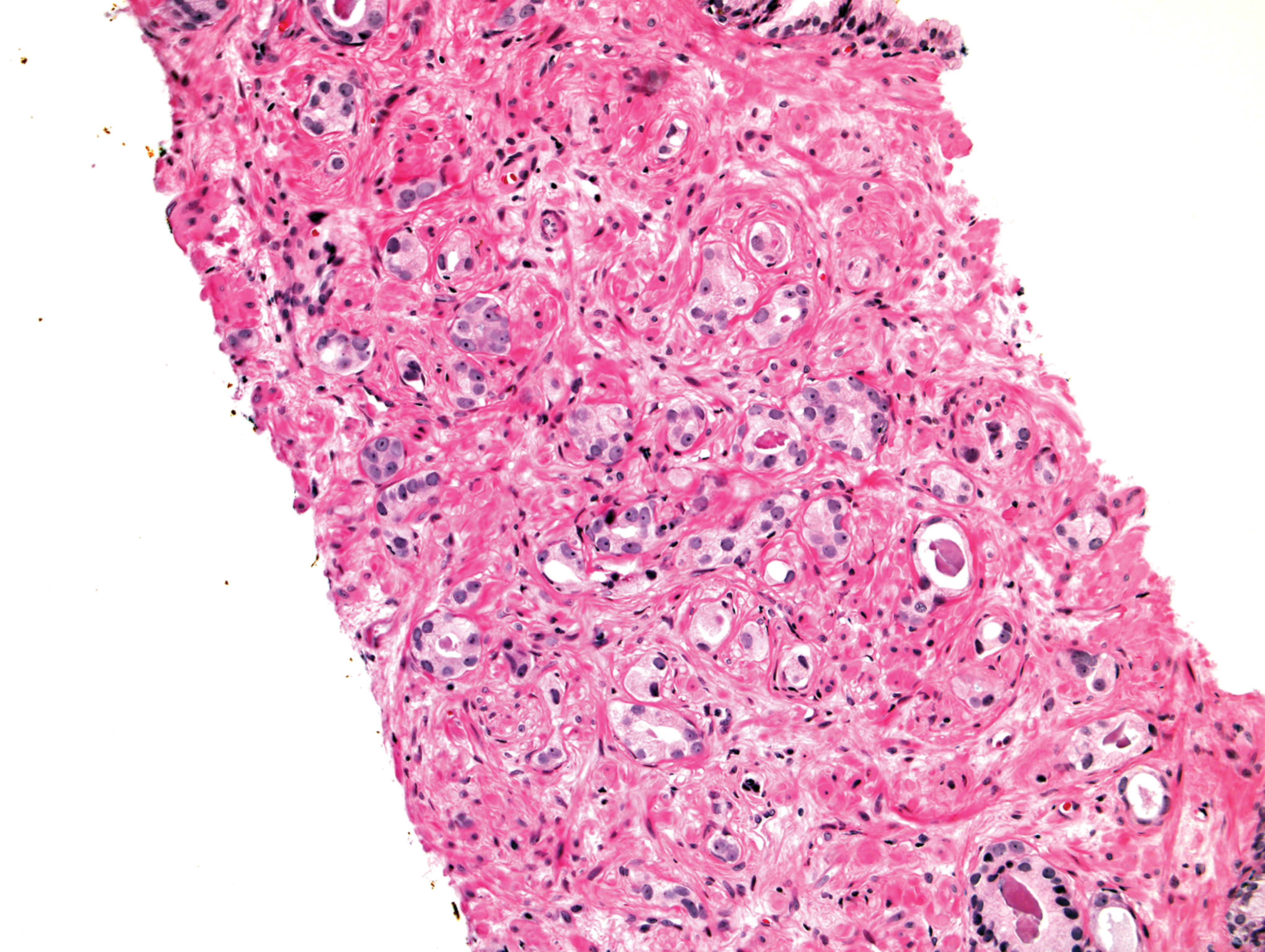 Diseases of the prostate (Chapter 35) - Silverberg's Principles 