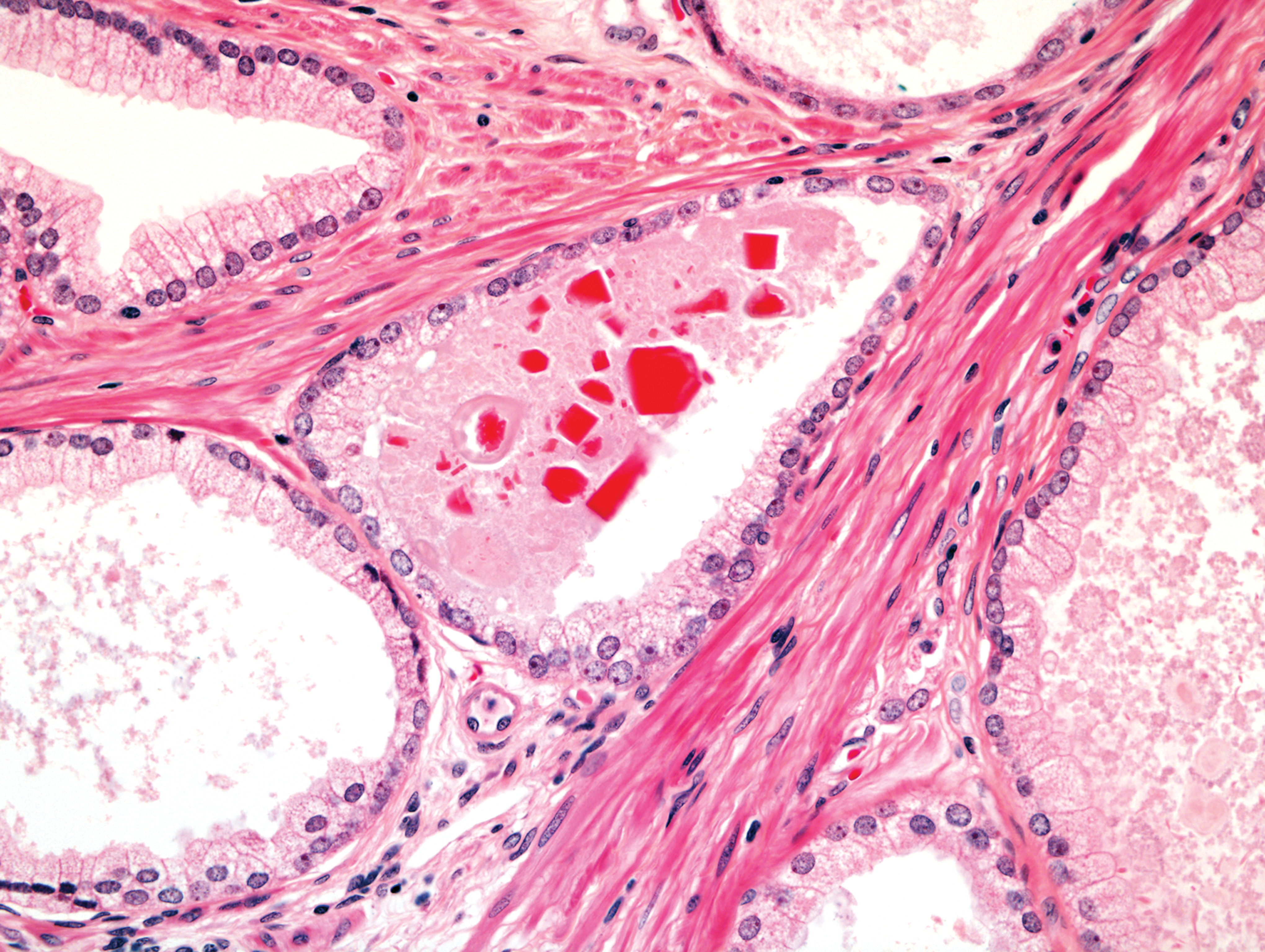 Diseases of the prostate (Chapter 35) - Silverberg's Principles 