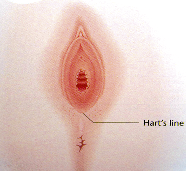 The vulva and vagina (Chapter 37) - Silverberg's Principles and Practice of Surgical Pathology and Cytopathology The vulva and vagina (Chapter 37) - Silverberg's Principles and Practice of Surgical Pathology and Cytopathology