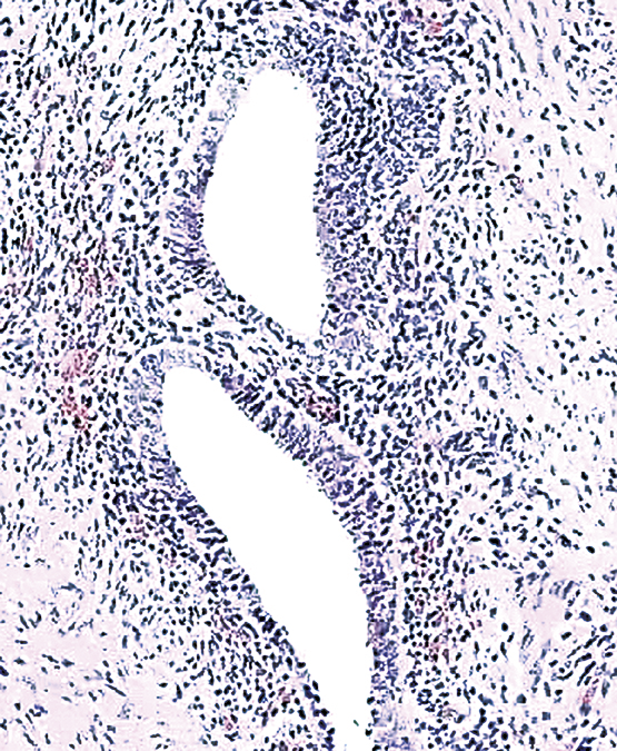 Endometrial Amoebiasis: A Rare Cause of Postmenopausal Vaginal Discharge