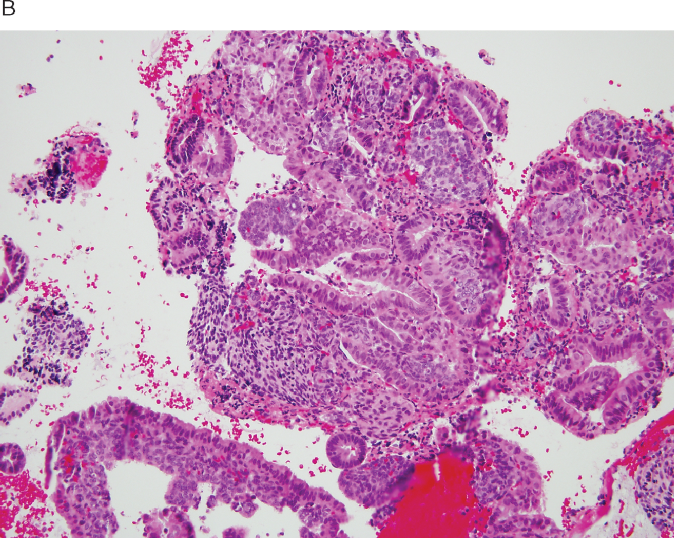 Endometrium histology proliferative Mucinous endometrial