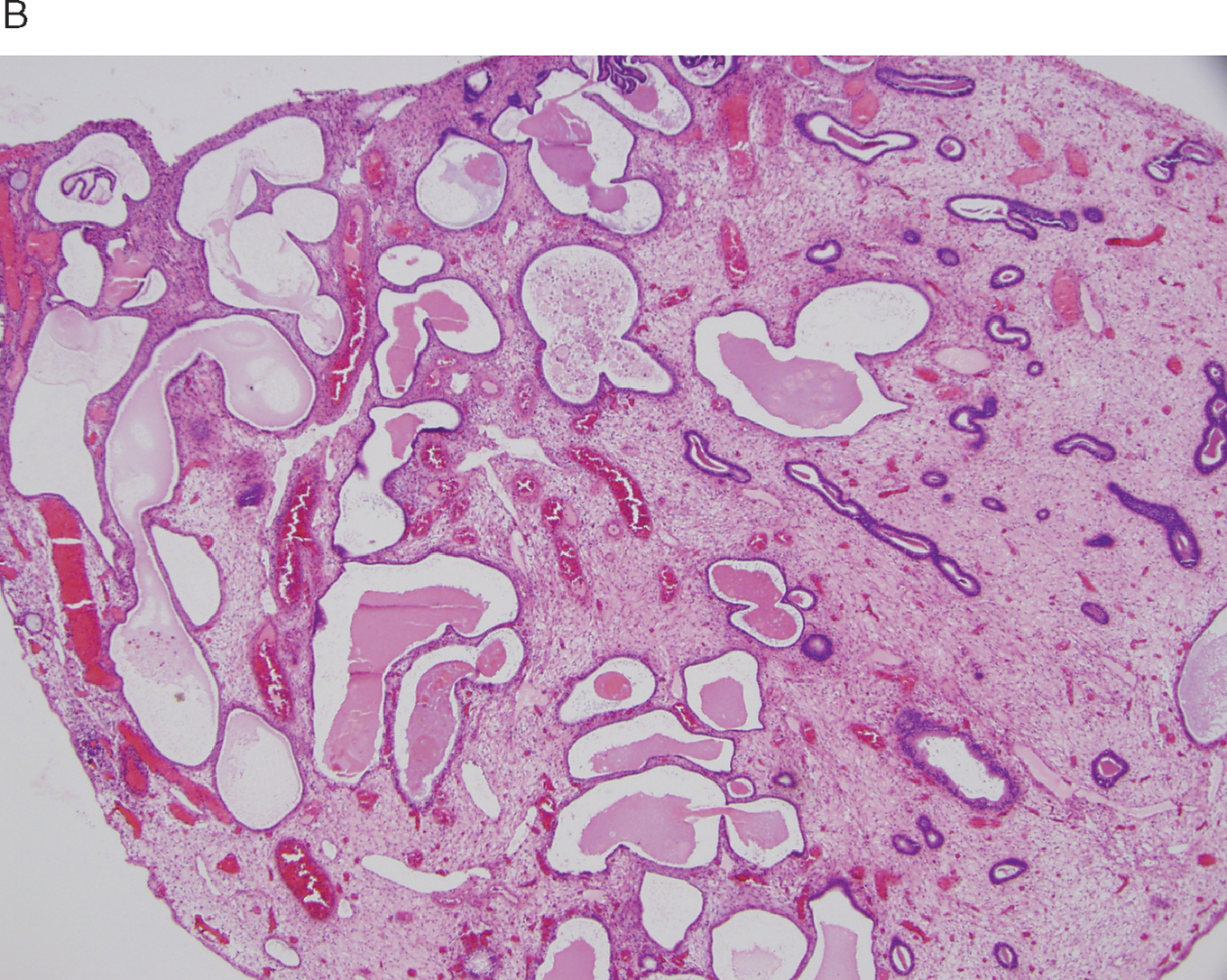 10 A section uterus by pathologist with, in the white ring, a