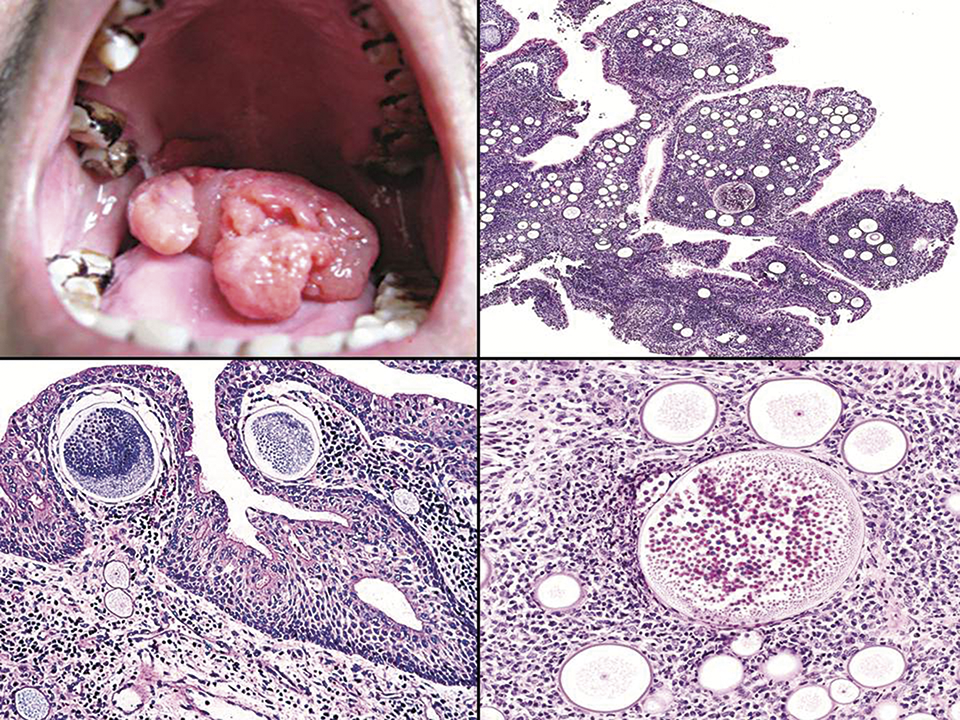 Rhinosporidium seeberi síntomas de diabetes