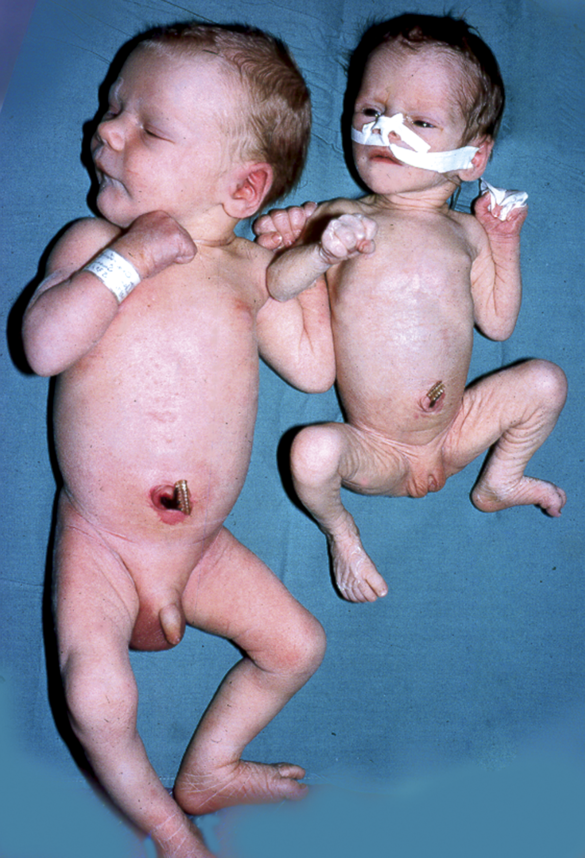 small placenta but healthy baby