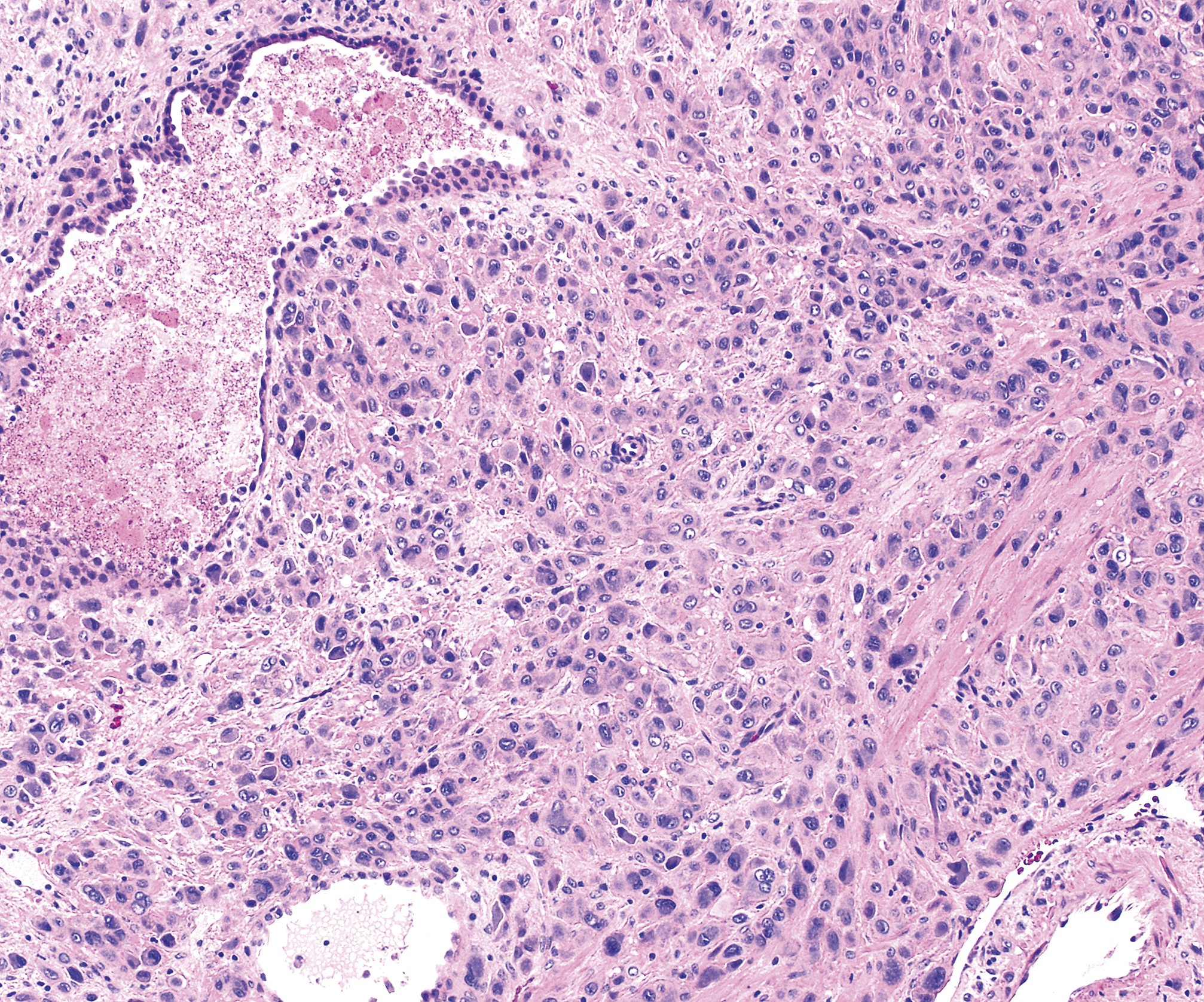 Placental Site Nodule (PSN): An Uncommon Diagnosis with a Common