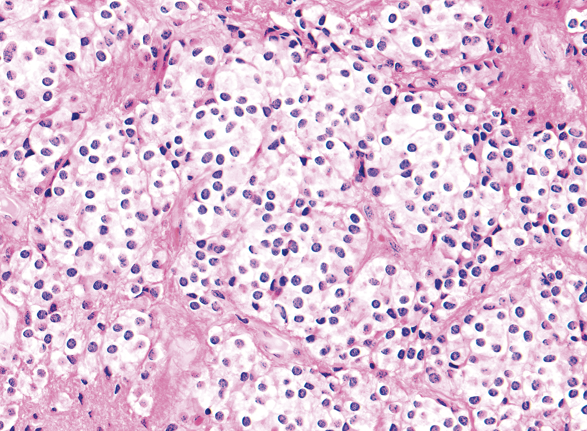pix Clear Cell Ependymoma Pathology Outlines the central nervous system chapter 48