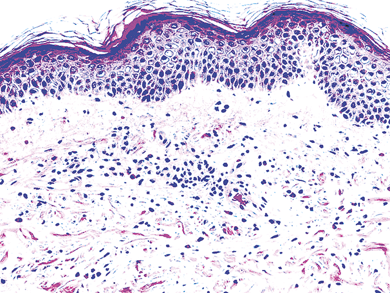 erythema annulare centrifugum histology