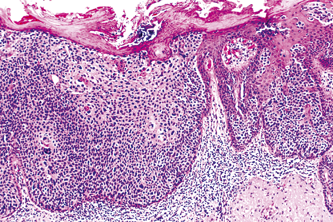 HPV-fertőzés tünetei és kezelése - HáziPatika Papillomatosis torok