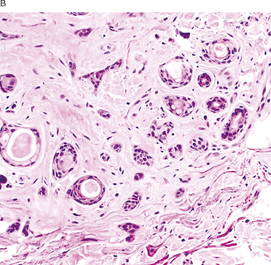 Cutaneous Tumors And Tumor Like Conditions Chapter 8