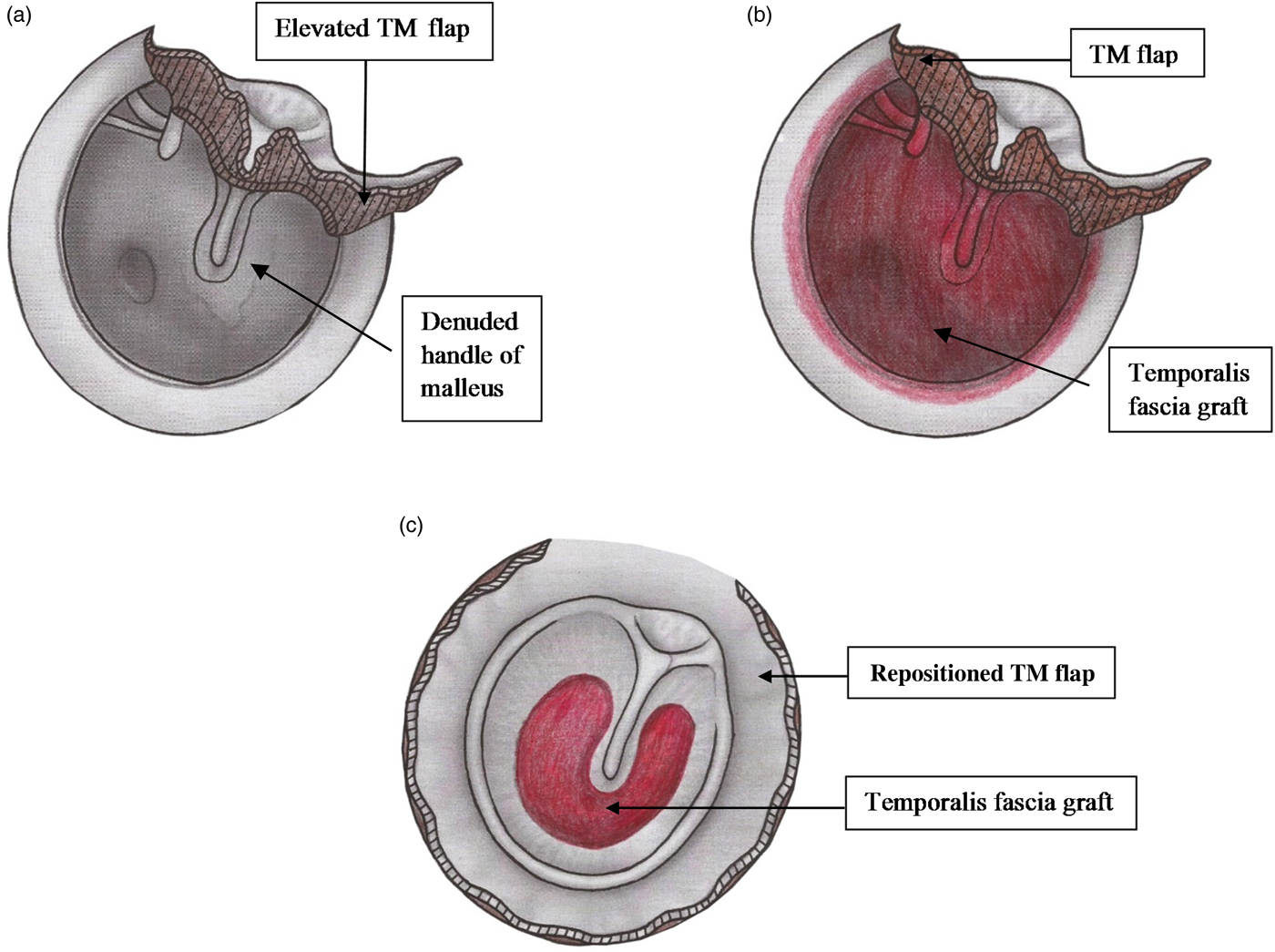 Role of circumferential subannular tympanoplasty in anterior and