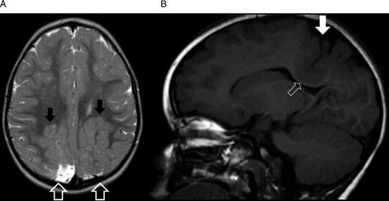 Polymicrogyria And Schizencephaly Chapter 48 The Causes