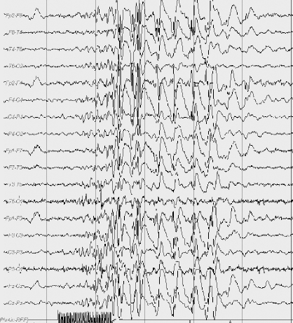 Provoked Epilepsies Section 4 The Causes Of Epilepsy Provoked Epilepsies Section 4 The Causes Of Epilepsy