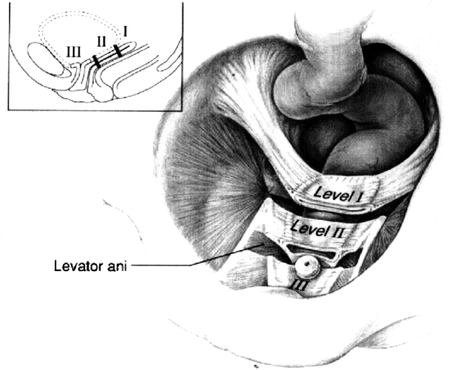 Pelvic Organ Prolapse – 21st Century Medical Education