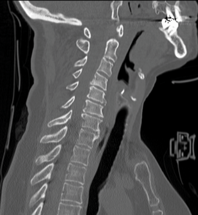 Cervical spine CT scan