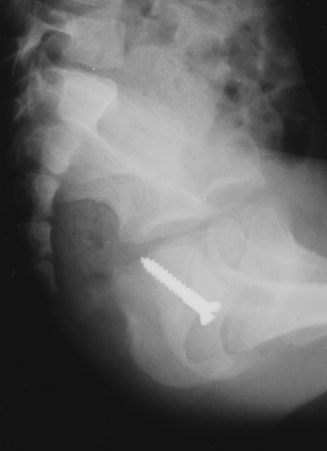 Foreign Bodies (Chapter 10) - Radiologic Guide to Orthopedic Devices