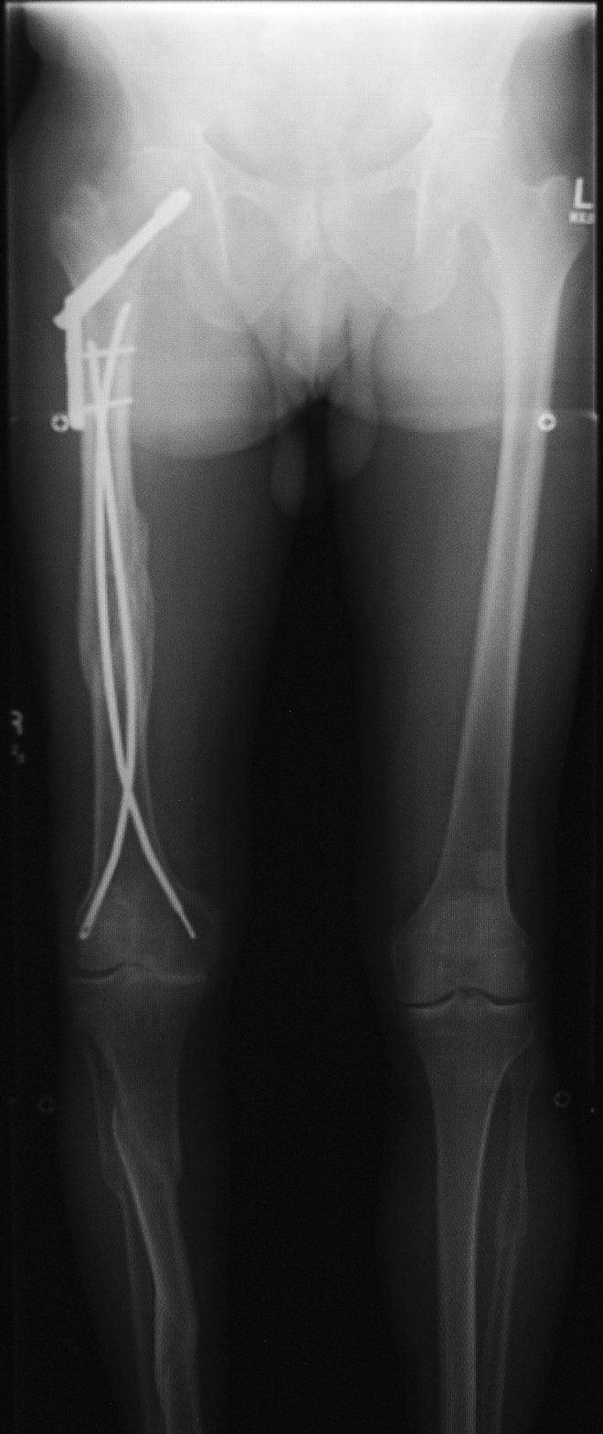 Fibular Intramedullary Nails: Indications, Trends, and Recent Results |  Podiatry Today