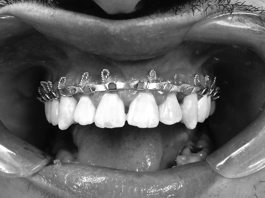 Intubating The Patient With Loose Teeth Chapter 47 Clinical Airway Management