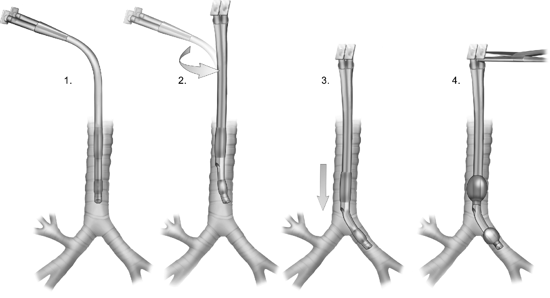 Double Lumen Tube For Single Lung Ventilation Chapter 51 Clinical Airway Management