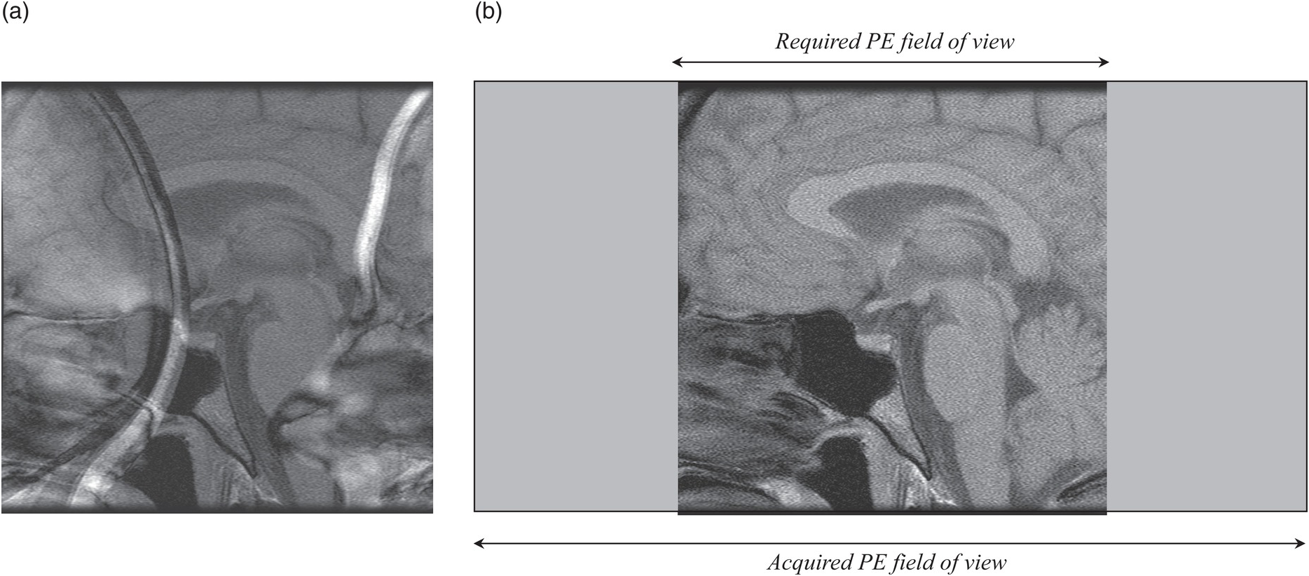 MRI oversampling, Fold-over suppression