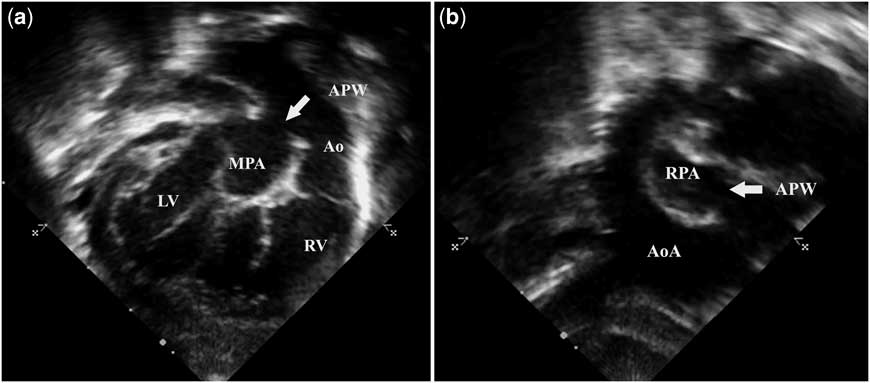 Aortopulmonary window: a rare mechanism of inter-circulatory mixing and ...