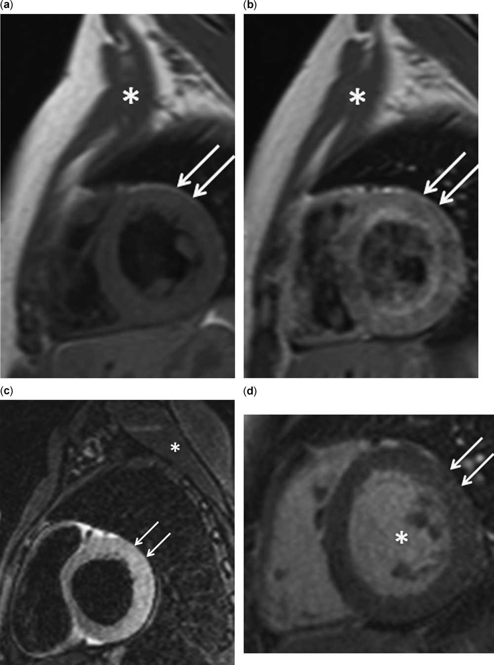 Transient left ventricular wall thickening in a 14-year-old girl with ...