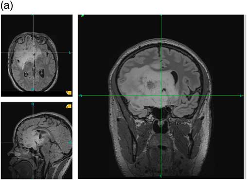 Retrait De Consentement Et Chirurgie Eveillee Illustration Et Enjeux Ethiques Canadian Journal Of Neurological Sciences Cambridge Core