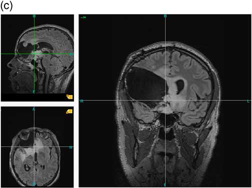 Retrait De Consentement Et Chirurgie Eveillee Illustration Et Enjeux Ethiques Canadian Journal Of Neurological Sciences Cambridge Core