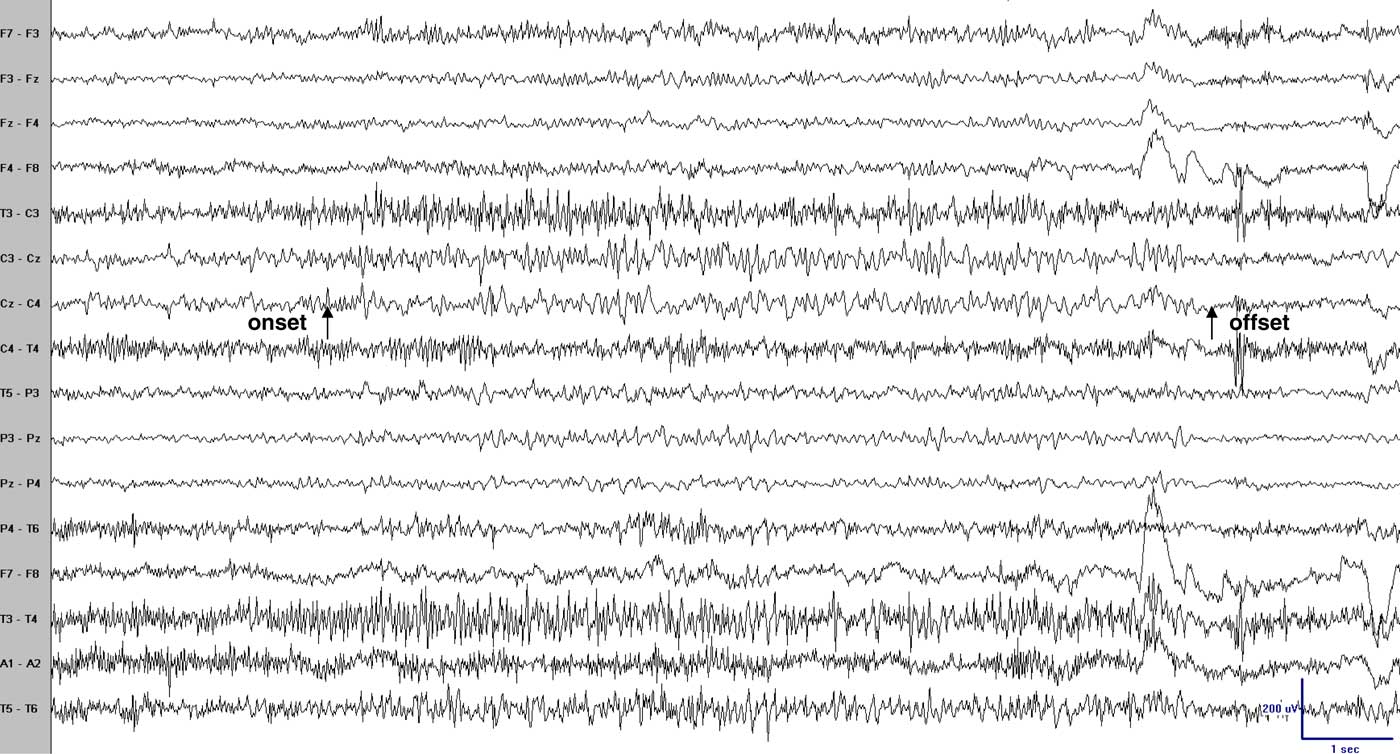 Peri-rolandic Seizures Manifesting as Reflex-induced Paroxysmal ...