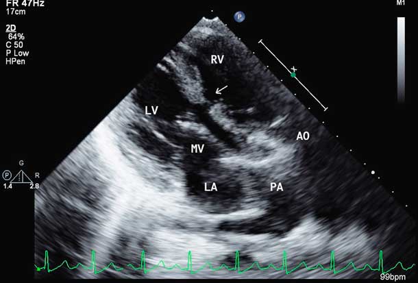 d-Transposition of the great arteries in a 12-year-old child: is ...