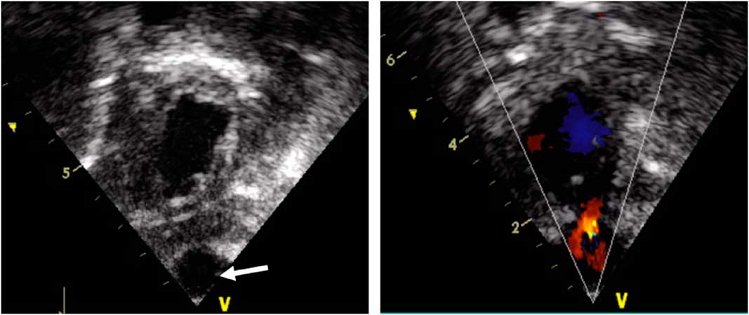 Congenital left ventricular diverticulum | Cardiology in the Young ...