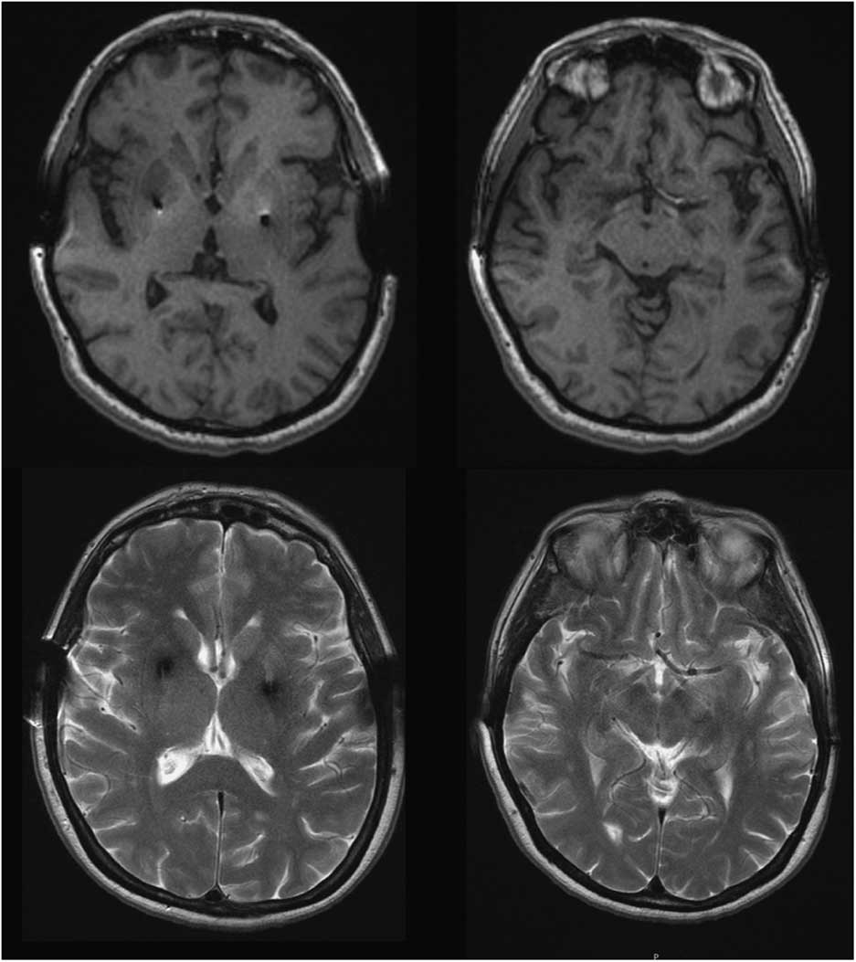 Coexisting Parkinson’s and Wilson’s Disease: Chance or Connection ...