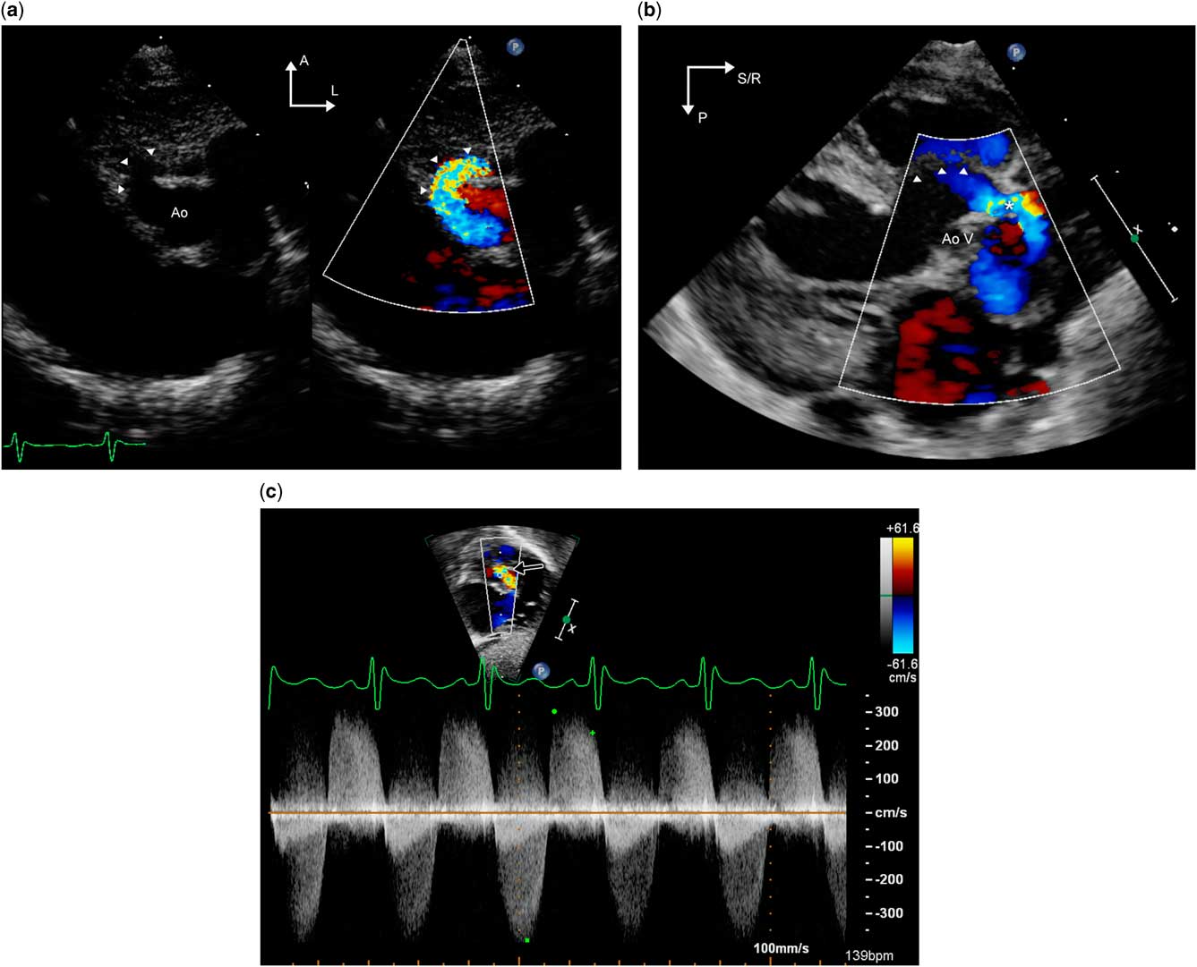 thoracic aortic aneurysm echocardiogram