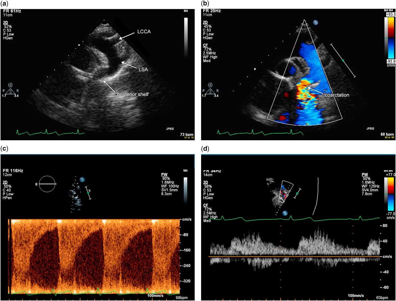 Echocardiography Of Coarctation Of The Aorta, Aortic Arch Hypoplasia ...