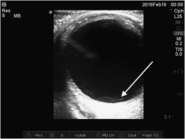 vitreous detachment ultrasound