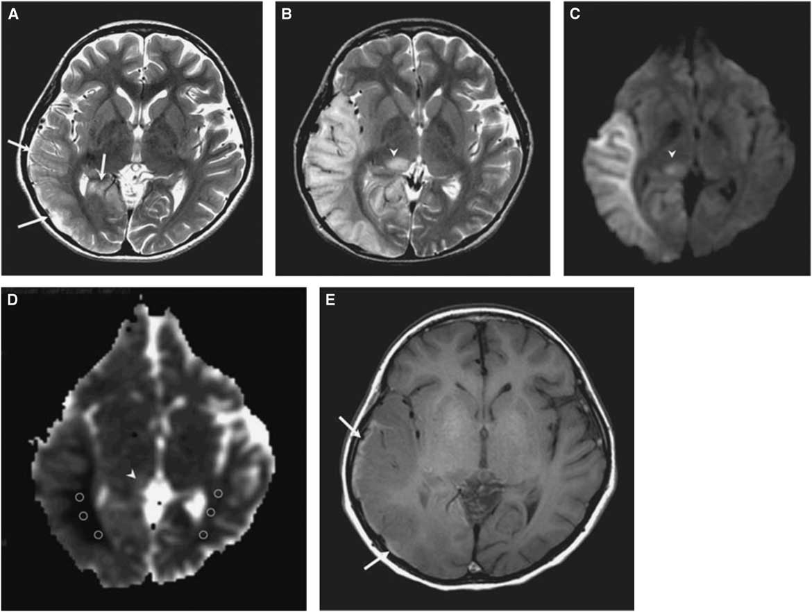 Cerebral Manifestations of Mitochondrial Disorders | Canadian Journal ...